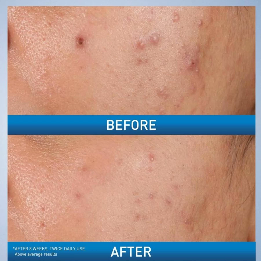 CeraVe Acne Treatment Gel with 2% Salicylic Acid, Glycolic Acid, Lactic Acid & Niacinamide for Clear Skin, Non-Drying, Alcohol-Free, Oil-Free, 1.35 Oz